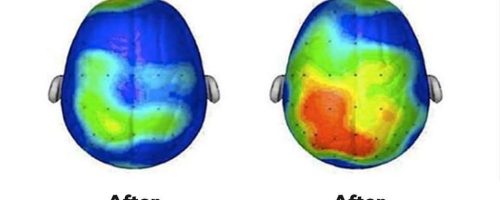 Πώς και πόσο βοηθάει η «μαλακή» σωματική δραστηριότητα (περπάτημα)